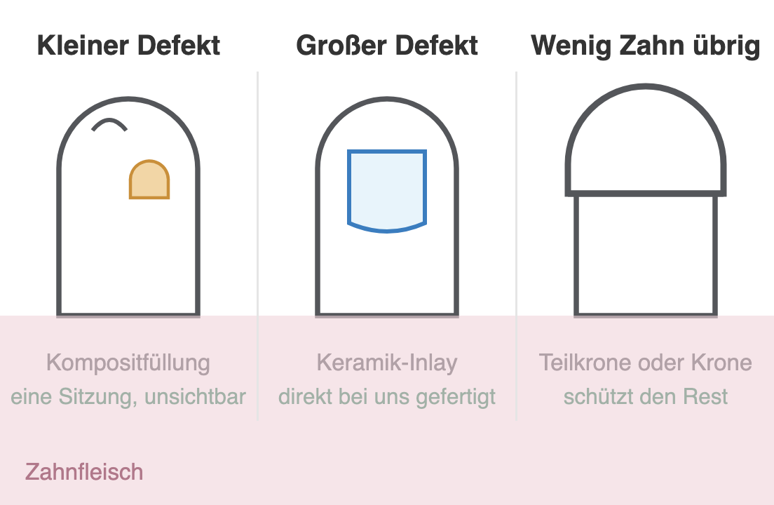 Schema: Kompositfüllung bei kleinem Defekt, Keramik-Inlay bei großem Defekt, Krone bei stark zerstörtem Zahn