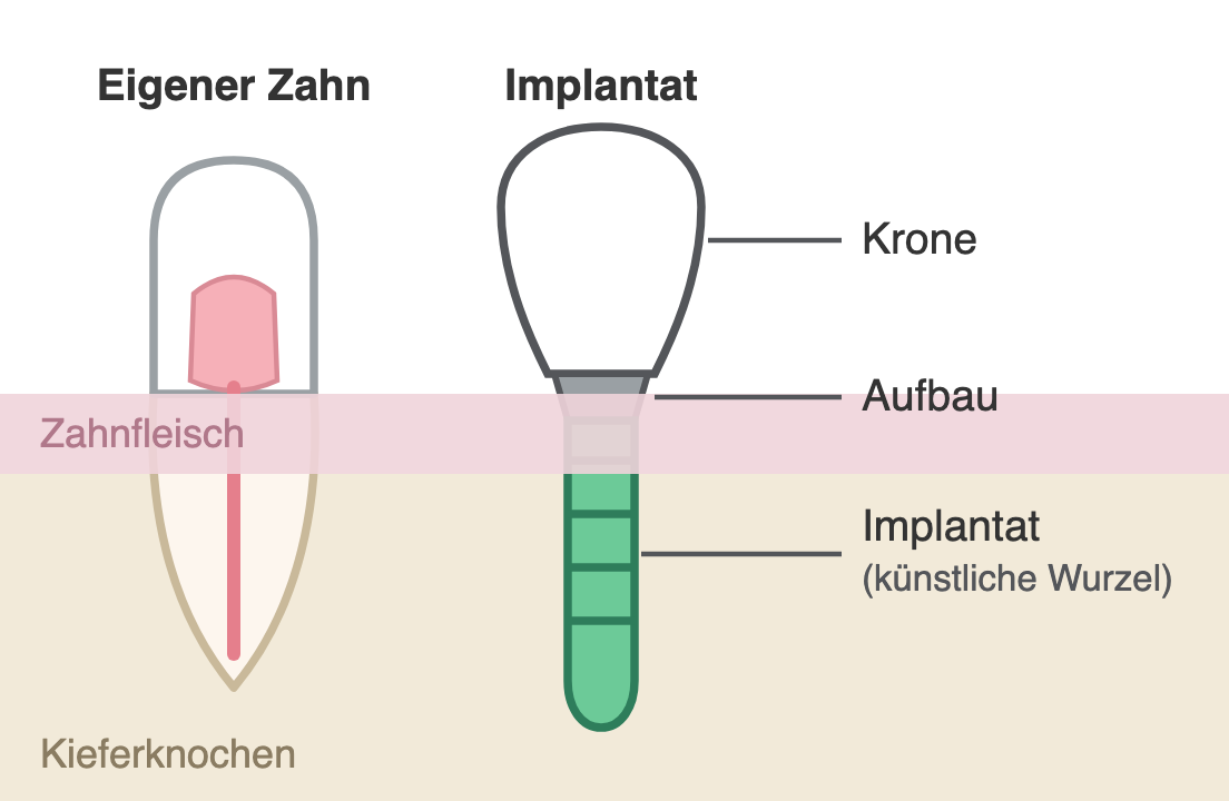 Schema: eigener Zahn mit Krone und Wurzel neben einem Implantat mit Krone, Aufbau und künstlicher Wurzel im Kieferknochen