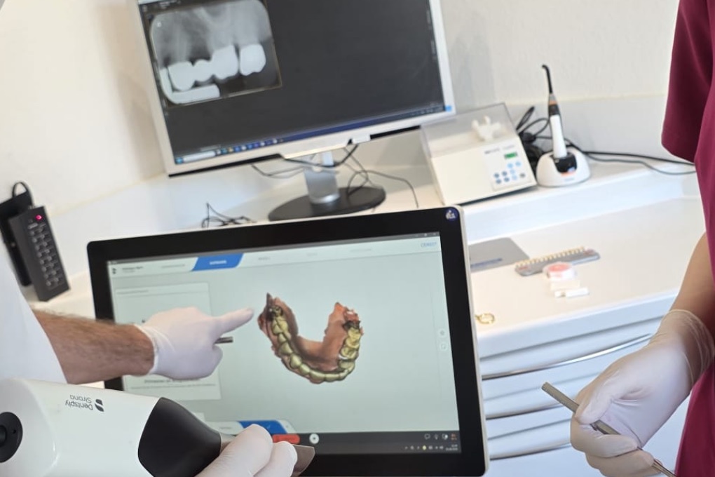 Intraoralscanner und 3D-Scan der Zähne auf dem Bildschirm, Grundlage für Keramik-Inlays direkt in der Praxis in Rheine