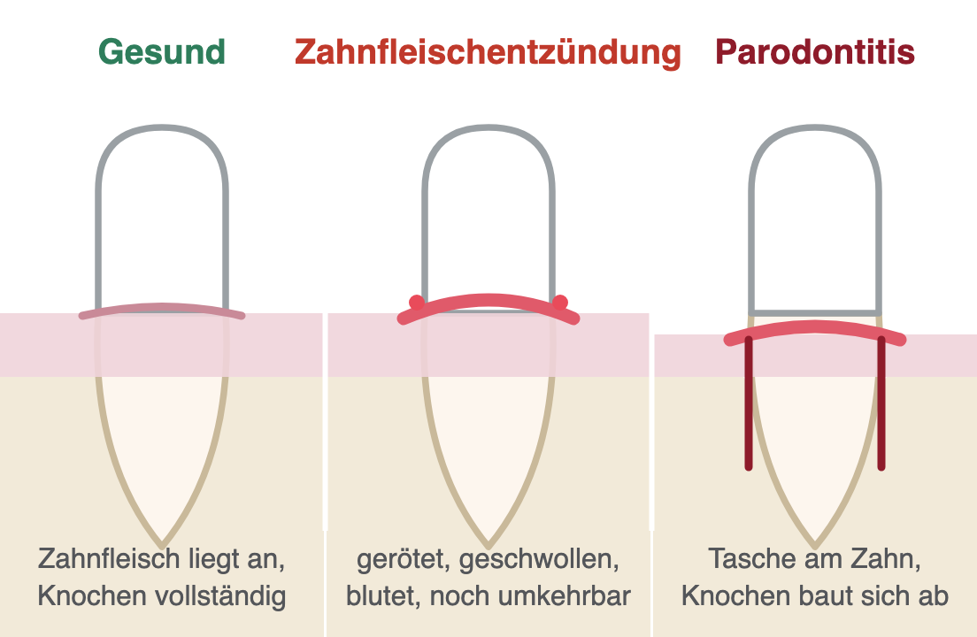 Schema in drei Stufen: gesundes Zahnfleisch, Zahnfleischentzündung, Parodontitis mit Zahnfleischtasche und Knochenabbau am Zahn