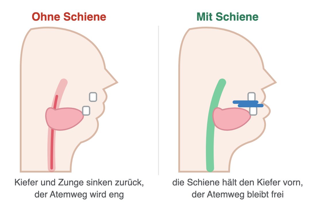 Kopf im Profil: ohne Schiene sinken Unterkiefer und Zunge zurück und verengen den Atemweg, mit Protrusionsschiene bleibt der Unterkiefer vorn und der Atemweg frei
