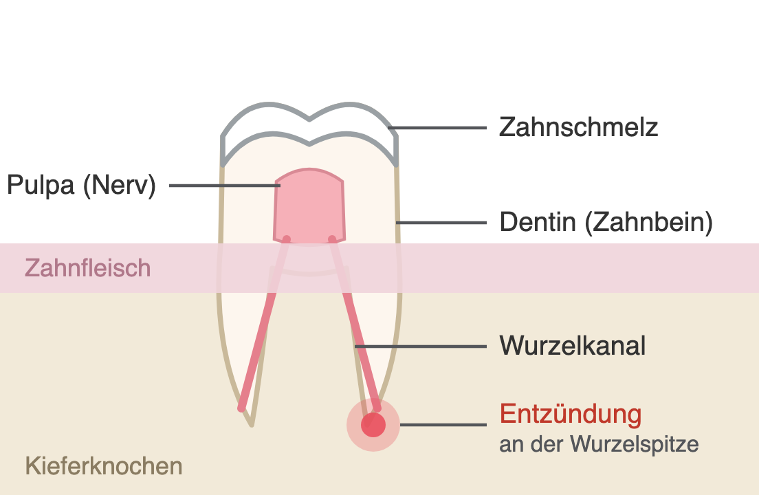Querschnitt eines Backenzahns: Zahnschmelz, Dentin, Pulpa mit zwei Wurzelkanälen und eine Entzündung an der Wurzelspitze