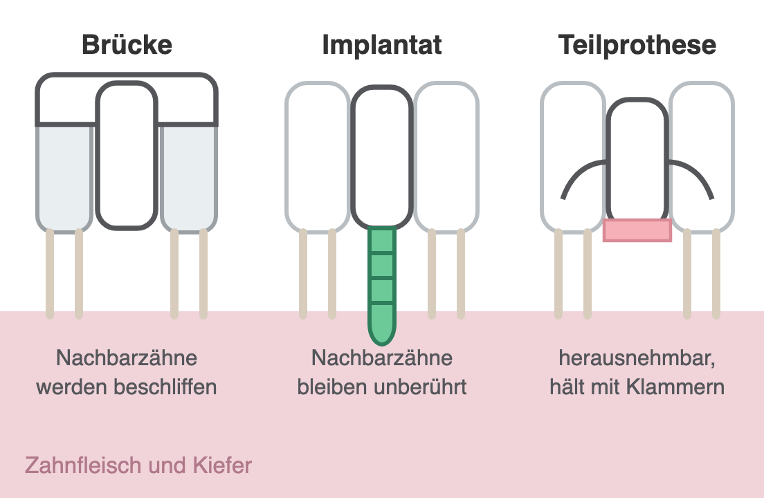 Schema: drei Wege bei einer Zahnlücke, Brücke mit beschliffenen Nachbarzähnen, Implantat mit Krone, Teilprothese mit Klammer